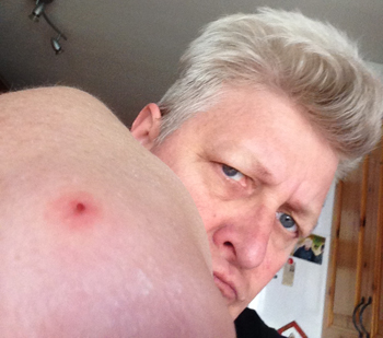 Myggbett på armbågen