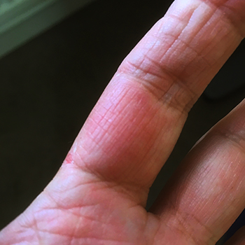  Getingstunget finger