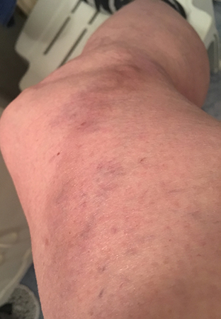 Tromboflebiten tor morgon 11 jan 2018