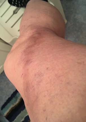 Tromboflebiten ons morgon 10 jan 2018