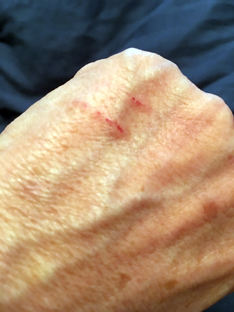 Rivmärken på handen från Mini