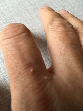 Skrapat finger Skrapat finger