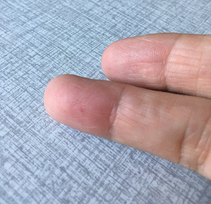 Humlestick i fingret Humlestick i fingret