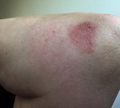 Armbågen och bettet 21 aug morgon