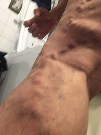 Tromboflebiten 22 mars 2020 fm