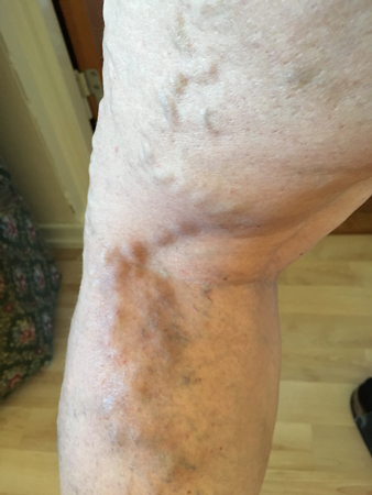 Tromboflebiten ur annan vinkel 22 mars 2020 fm