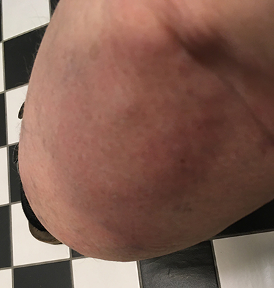 Tromboflebiten 17 mars 2020 kväll