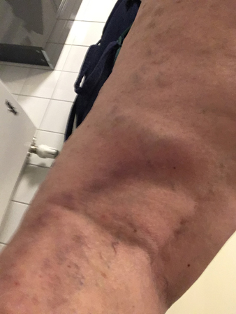 Tromboflebiten 21 mars 2020 kväll