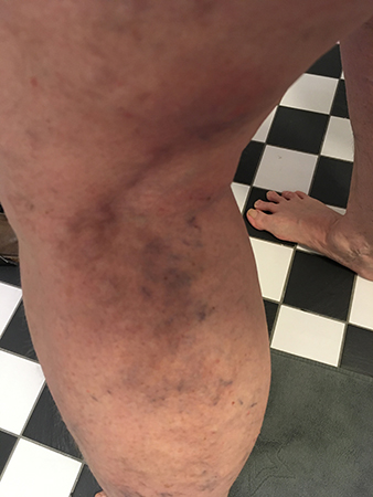 Tromboflebiten morgon 30 mars 2020