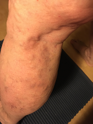 Tromboflebiten midnatt 28 mars 2020