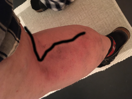 Tromboflebiten 20 mars 2020 kväll