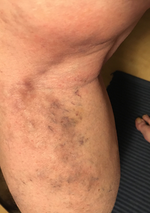 Tromboflebiten kväll 27 mars 2020