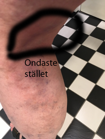 Tromboflebiten kväll 26 mars 2020