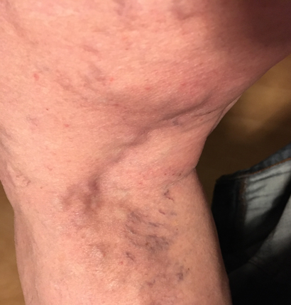 Tromboflebiten kväll 3 april 2020