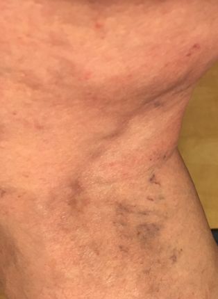 Tromboflebiten kväll 6 april 2020