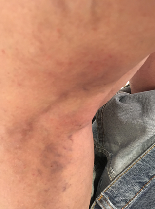 Tromboflebiten kväll 4 april 2020