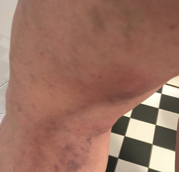 Tromboflebiten kväll 2 april 2020