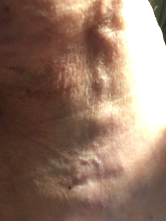 Tromboflebiten kväll 5 april 2020