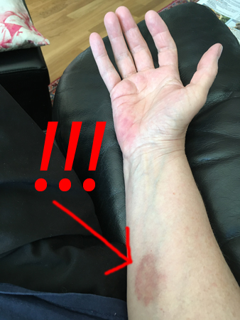 Getingstick på väg att blekna