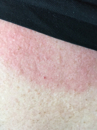 Solbränd på övre delen av ryggen närmast nacken