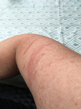 Blessyr efter trädgårdsarbete