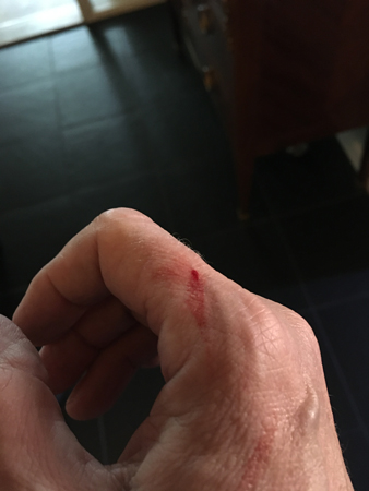 Sår på fingret
