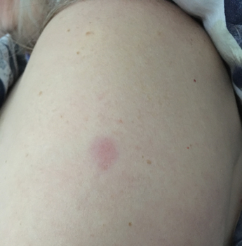 Märke efter vaccinspruta nr 2 på Anna