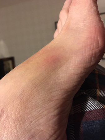 Blåmärke på foten