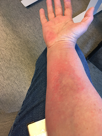 Getingstickarmen onsdag morgon