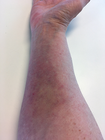 Getingstickarmen torsdag