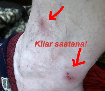 Två kliande myggbett på smalbenet