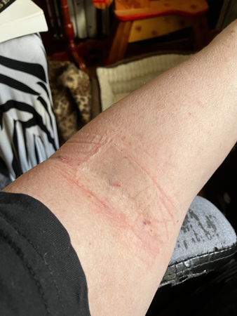 Röda märken i armvecket efter plåster