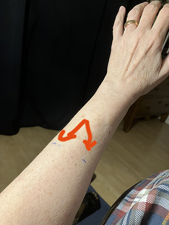 Markeringar på vänster arm