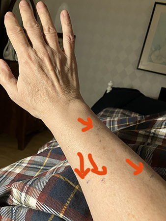 Markeringar på höger arm