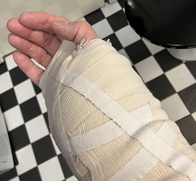 Omlindad hand ser ut som tennisboll