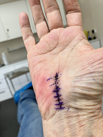 Stygnen på högerhanden