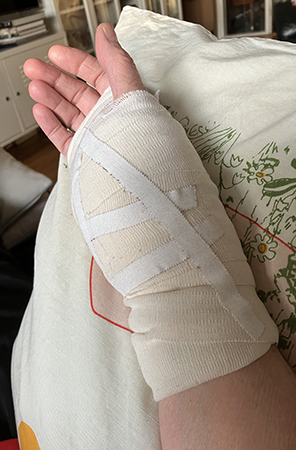 Bandagerad hand i högläge