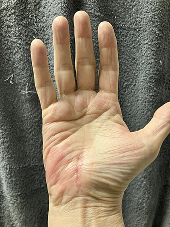 Opererade handen 14 mars 2023