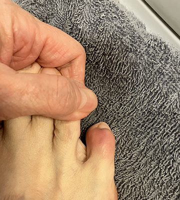 Röd lilltå efter smäll i fotpall