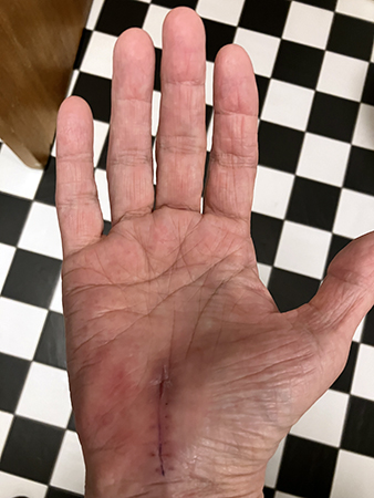 Opererade handen utan plåster