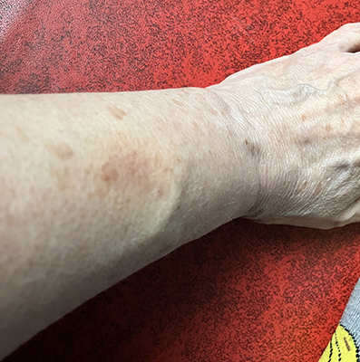 Blåmärke på vänsterarm