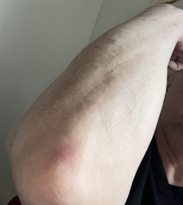 Blåmärke på höger armbåge