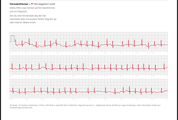 EKG med Fs applewatch visar förmaksflimmer