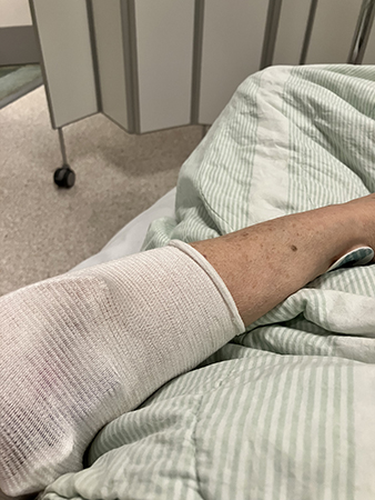 Infart i vänster arm