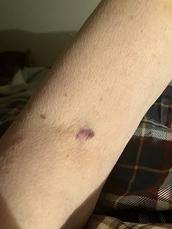 Lila armveck efter provtagning