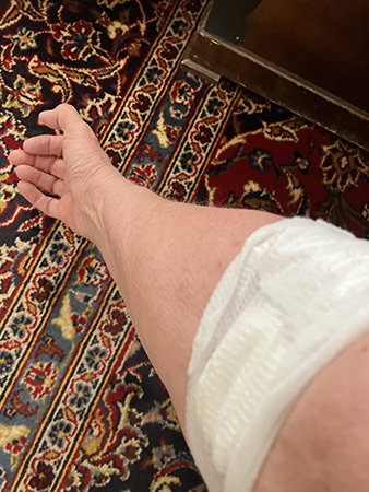 Kompress i armvecket efter provtagning