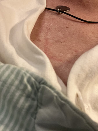 Röda märken på bröstkorgen efter konverteringen