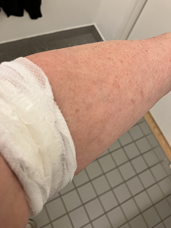 Omlindad arm efter provtagning