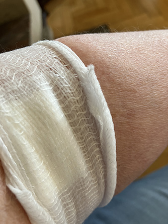 Strumpa i st f plåster efter venprovet i armen Strumpa i st f plåster efter venprovet i armen