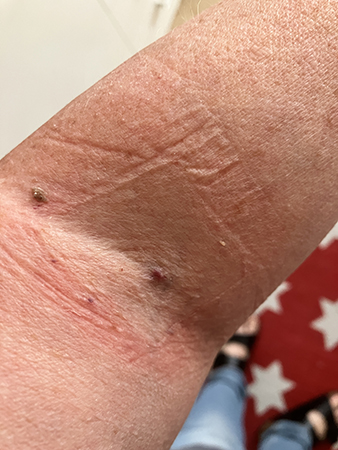 Eksem i armvecket efter kirurgtejpen